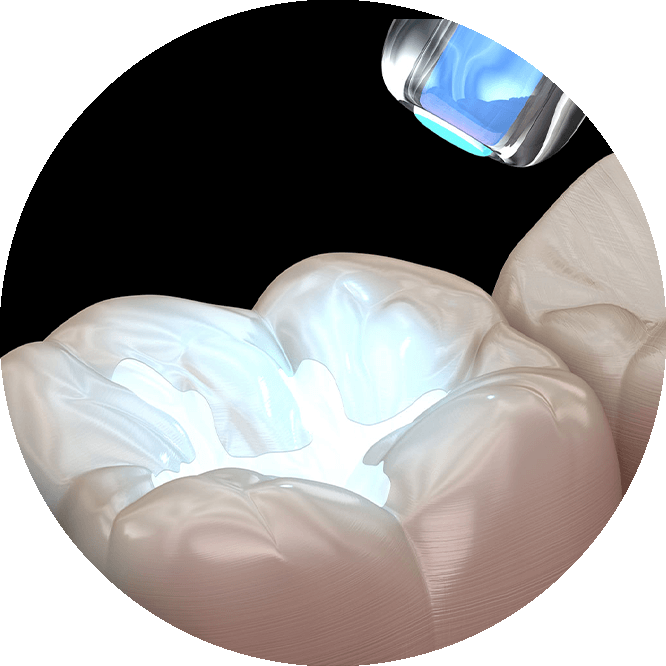 close up of cavity treatment