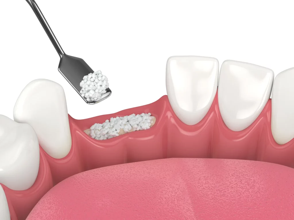 Dental bone graft procedure illustration showing synthetic bone material being applied to jawbone.