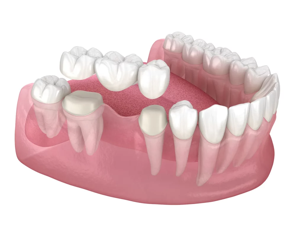 3D model showing dental bridge placement for missing teeth