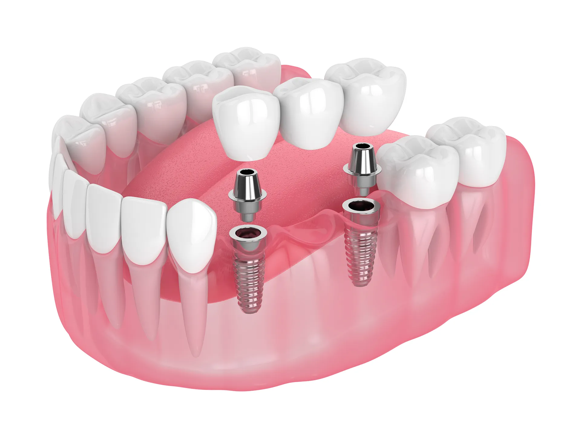 llustration of dental implants and crowns for teeth restoration.