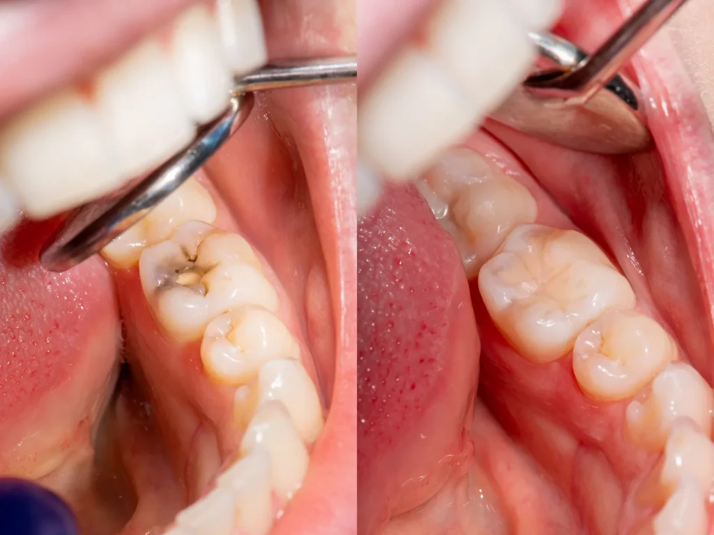 teeth fillings before and after treatment.