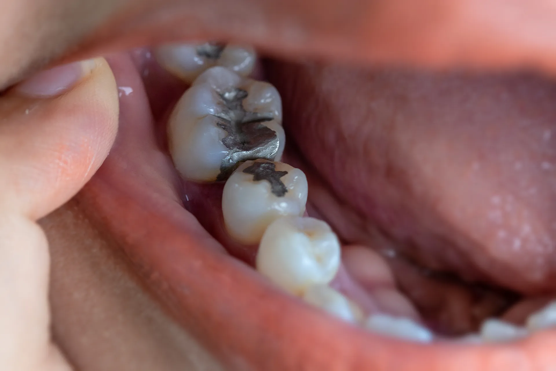 Close-up of teeth with dental fillings indicating oral health care.