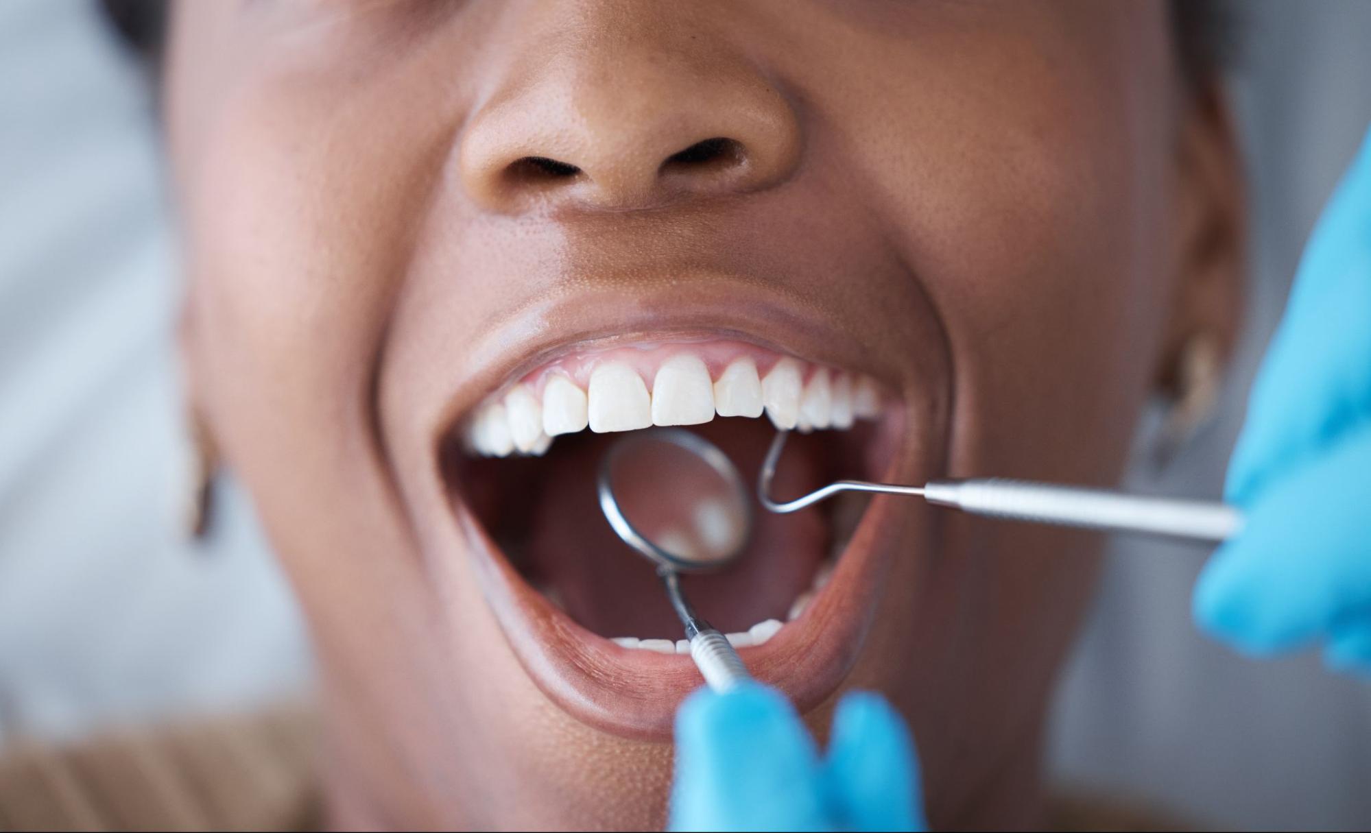 A close-up of a woman at a dental checkup for gum disease prevention, receiving an oral hygiene exam, cavity check, and teeth cleaning.