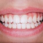 A close-up of a woman's smile showcasing healthy gums after gum disease treatment, highlighting strong teeth and improved oral health.