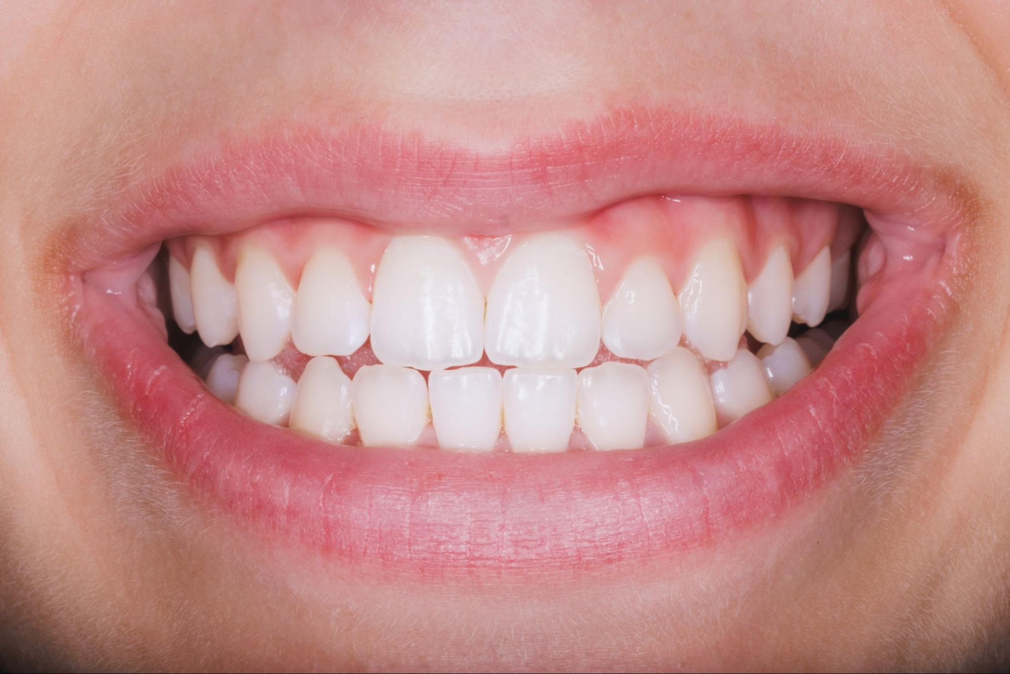 A close-up of a woman's smile showcasing healthy gums after gum disease treatment, highlighting strong teeth and improved oral health.