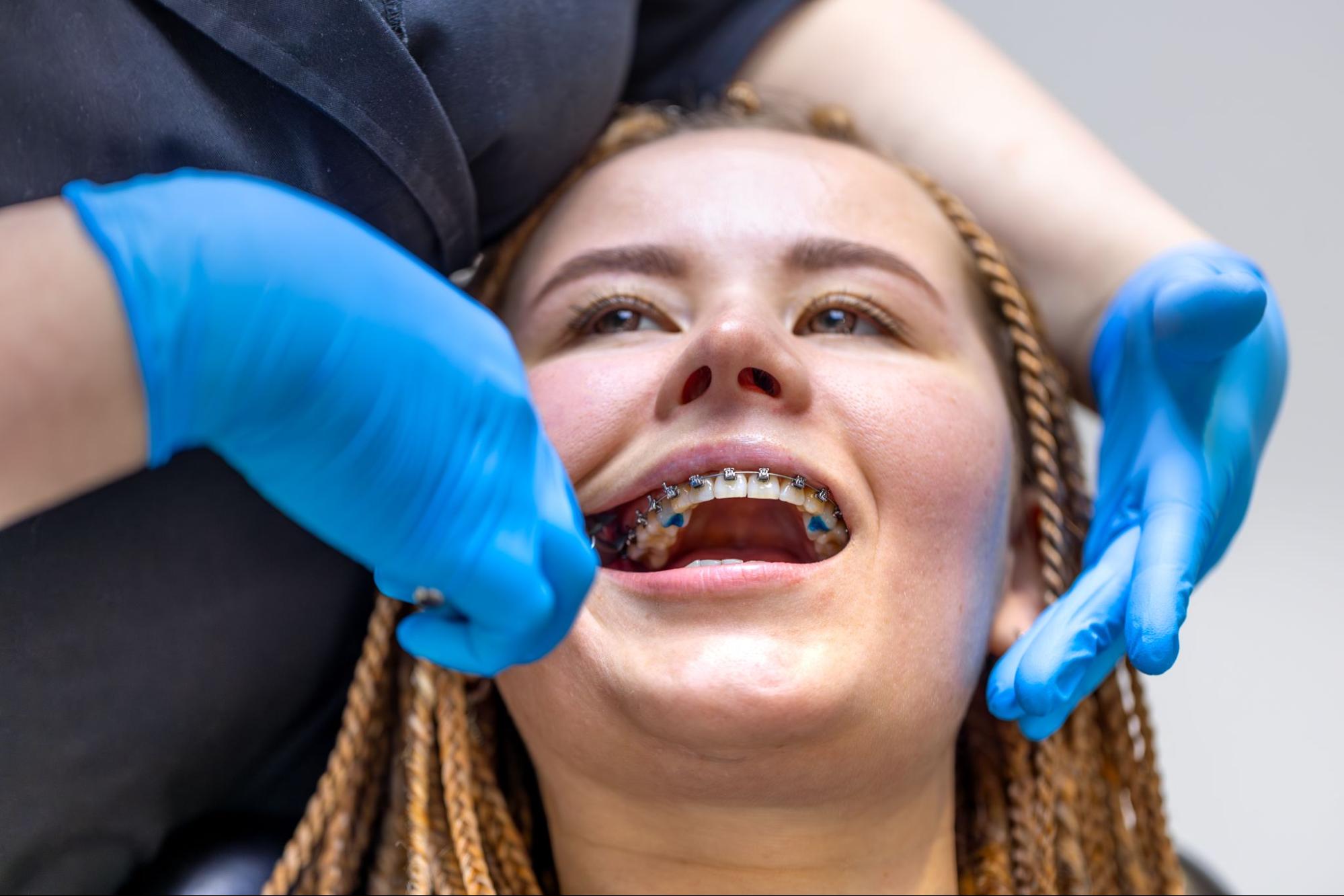 Close-up of a female teen patient receiving metal braces installation.