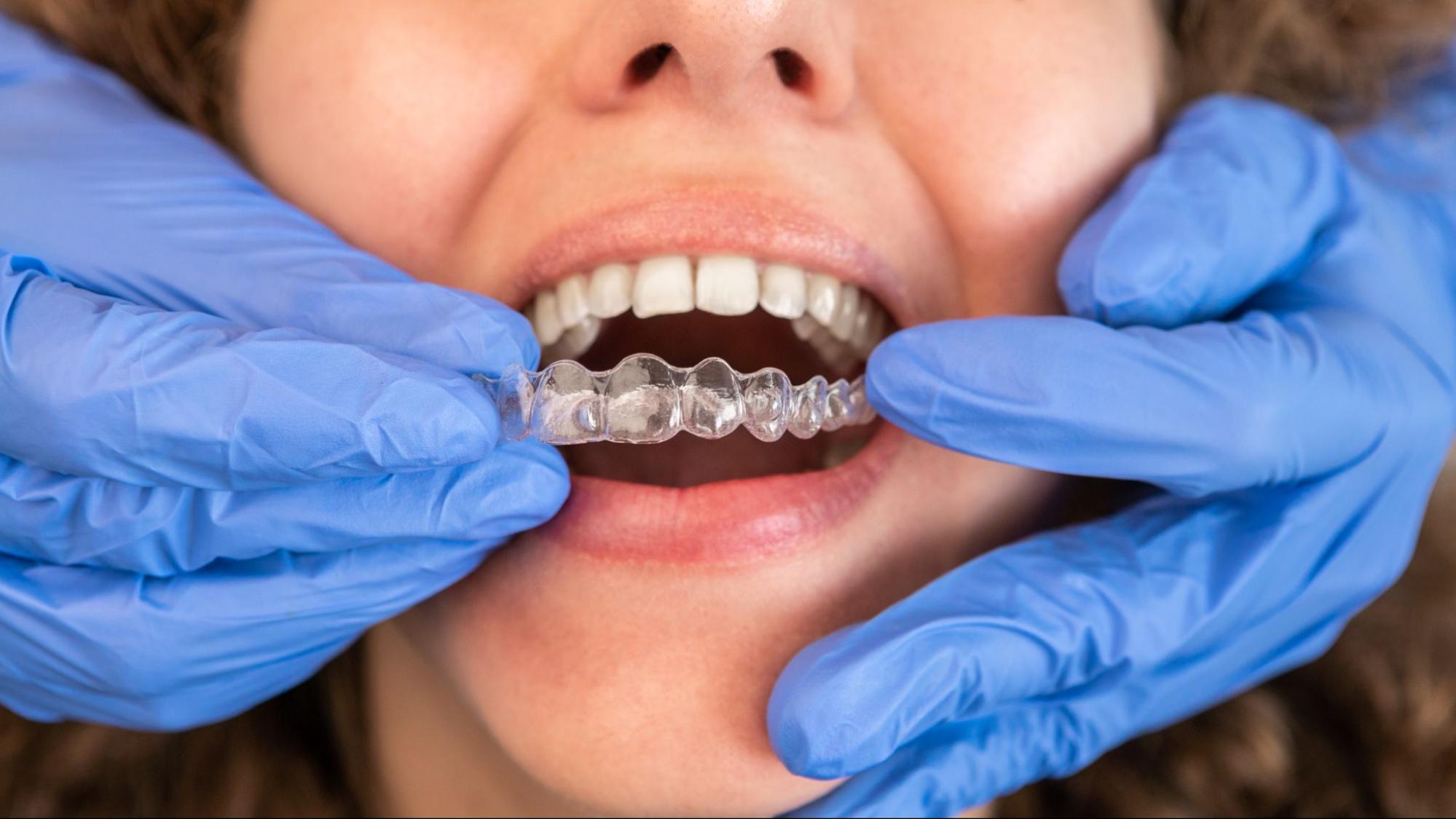 A dentist's hands applying an Invisalign® aligner.