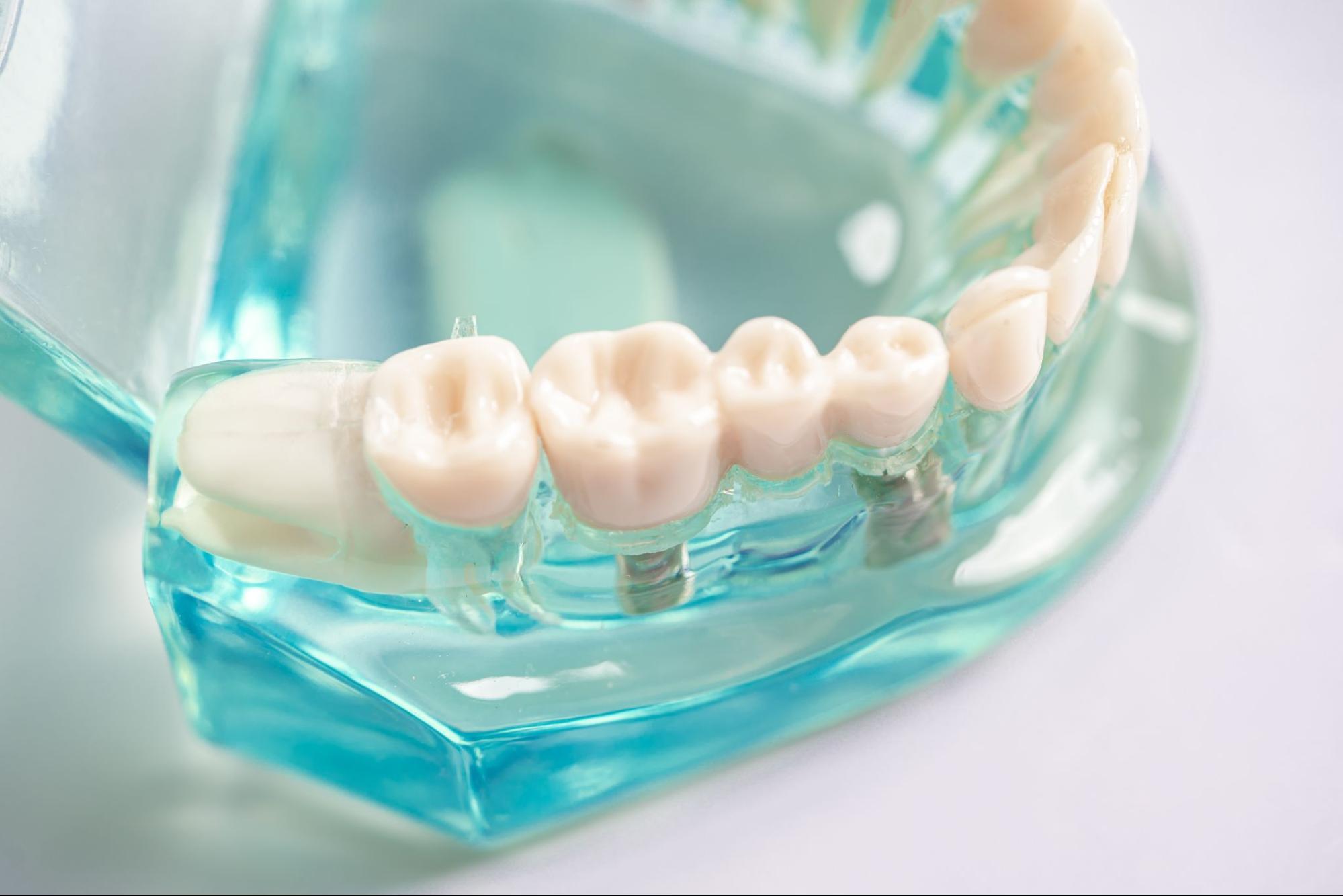 Top view of a dental implant model showing artificial tooth roots embedded in the jaw using a green plastic gum representation.