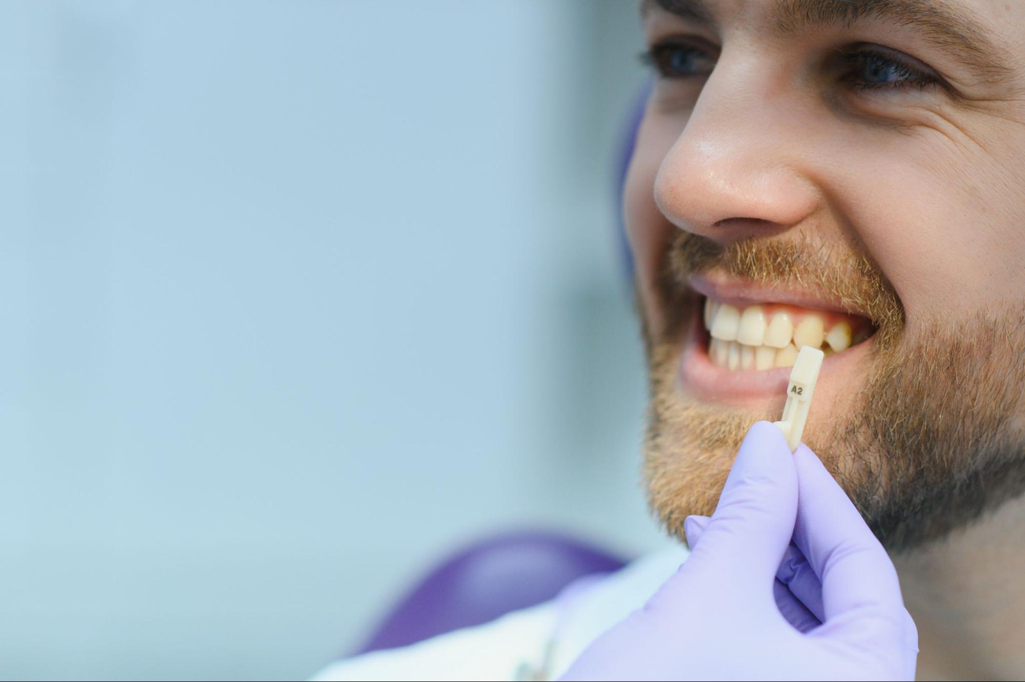 A close-up of a tooth shade guide held near a male patient's teeth, assisting in color matching for dental crown preparation.