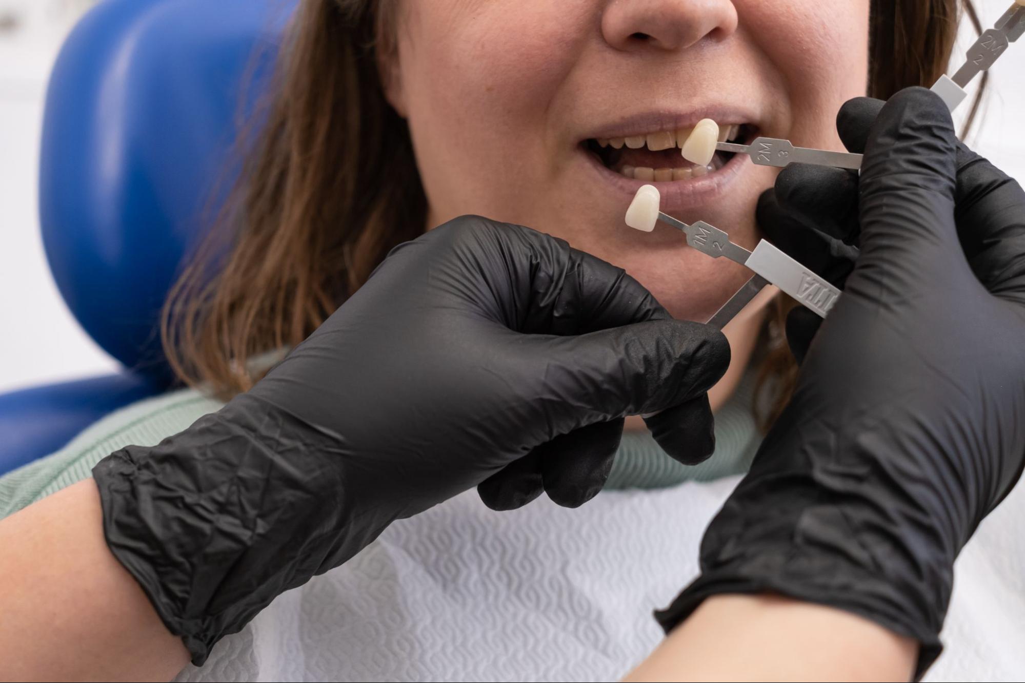 Dental professional matching tooth color samples for a veneer and whitening procedure.