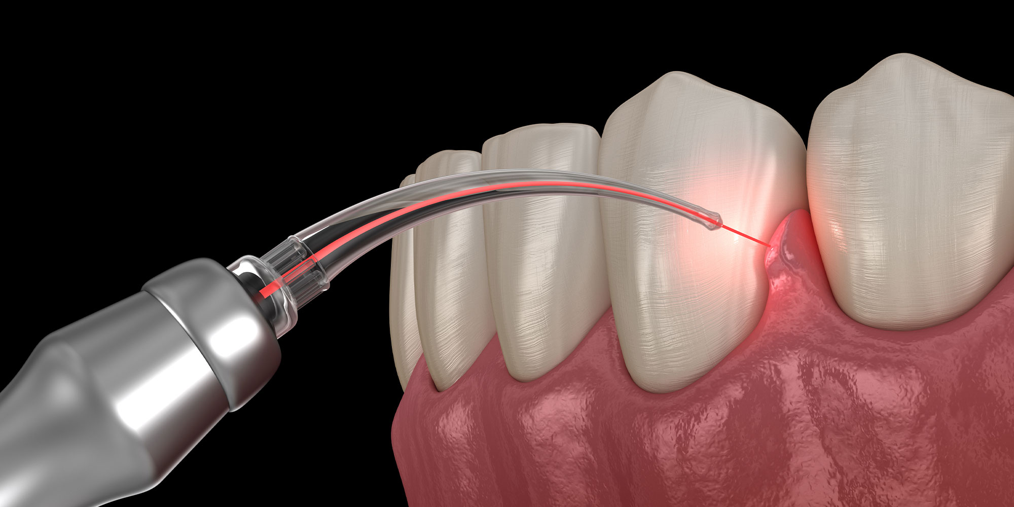 illustrated laser dentistry treatment
