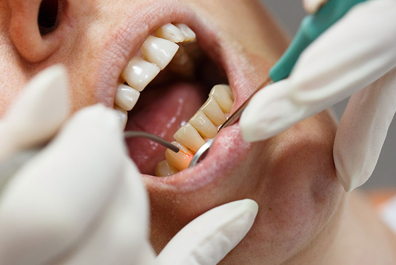 Dental laser used on a patient